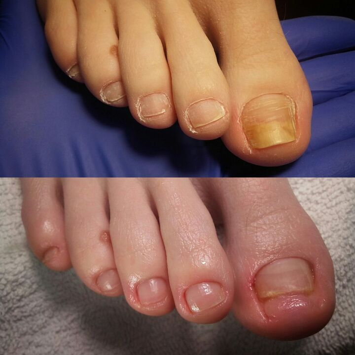 Before and after the application of Exodermin cream from Yesenia