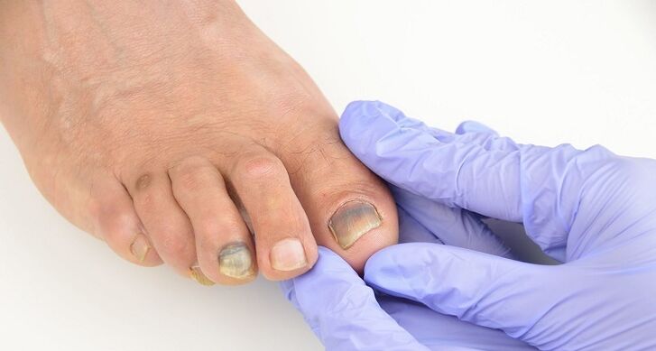 toenail exam for fungus