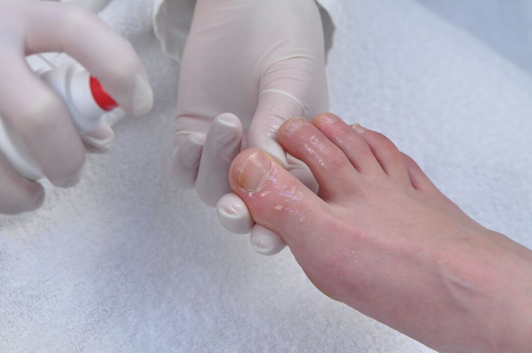 nail treatment with fungus