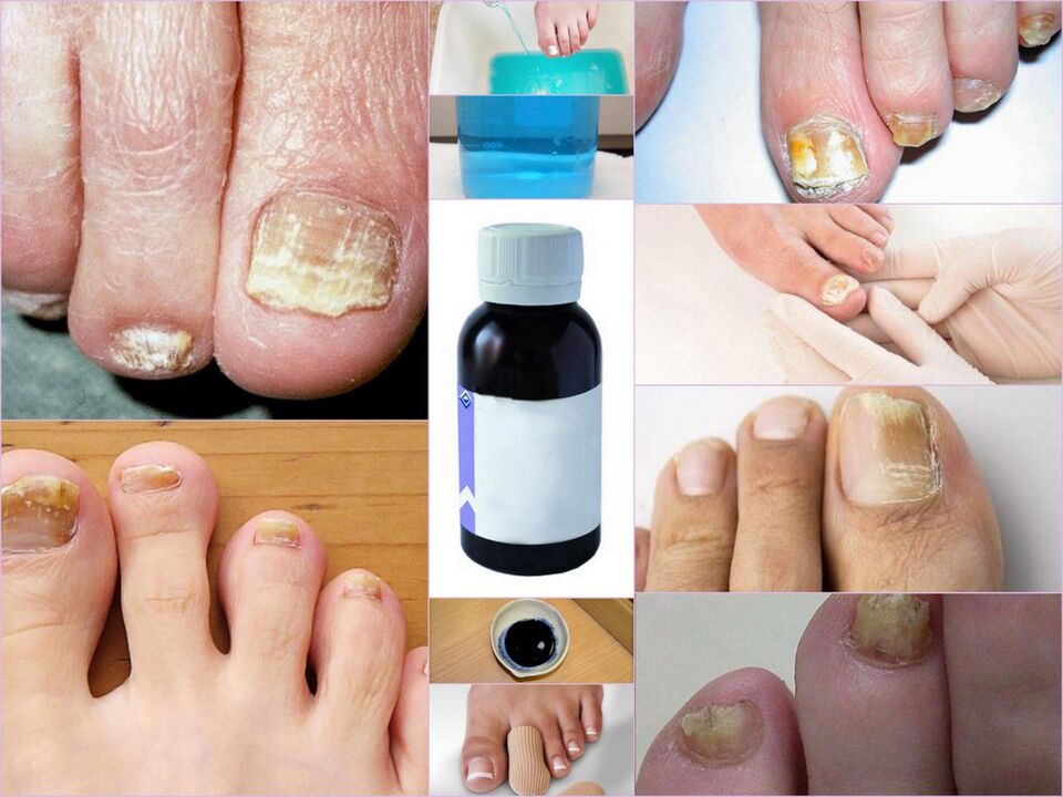 nail fungus medications