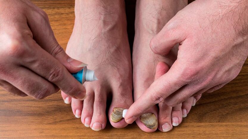 Apply an antifungal cream to your nails to treat onychomycosis