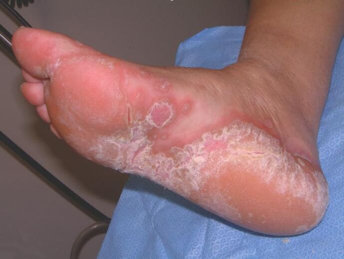 A foot with a fungal infection