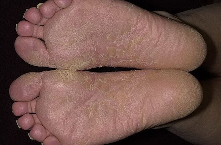 Dry, scaly skin on the feet is a sign of scaly yeast infection