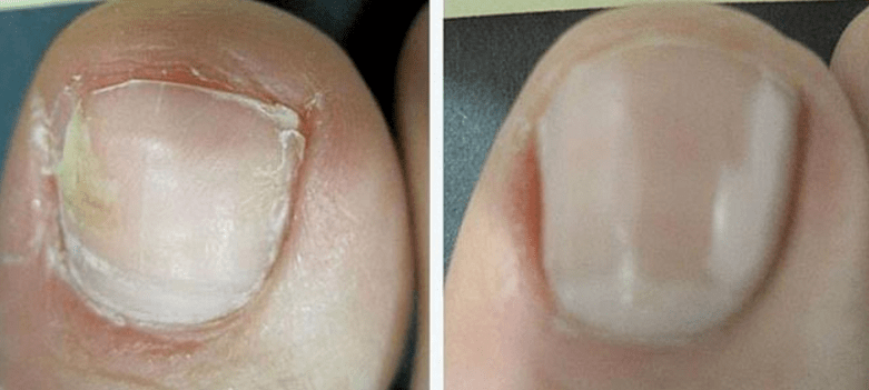 Toenail before and after treatment for the fungus