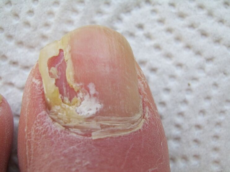 With onychomycosis, a deformation of the nail plate occurs