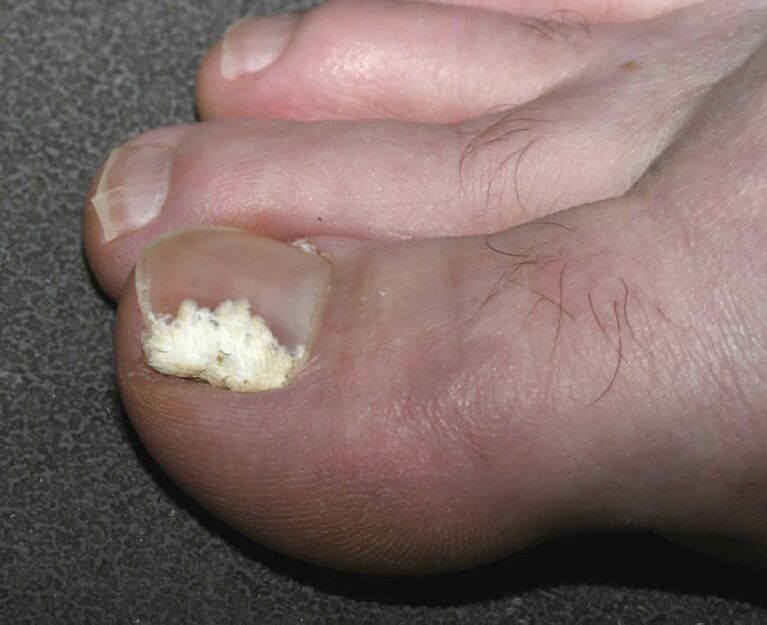 superficial nail fungus