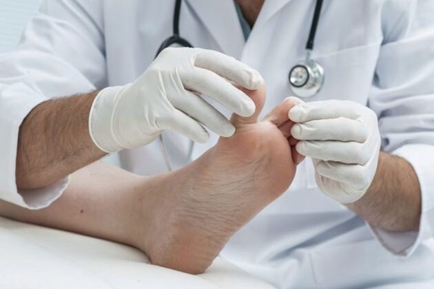 diagnosis of mycosis of the feet at the doctor