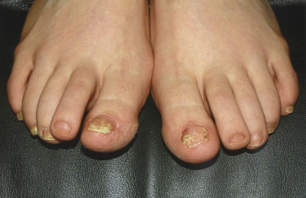 fungal nails