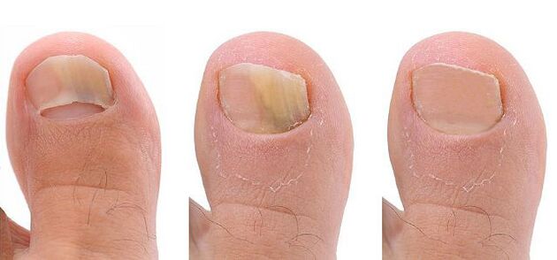 stages of nail fungus