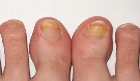 yellowing of nails with fungus