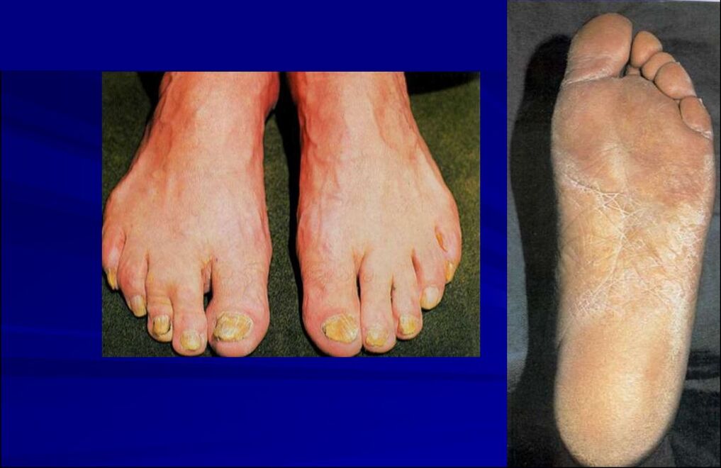 Scaly-hyperkeratotic form of the fungus (rubromycosis of the foot)