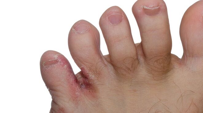 Signs of fungus between the toes - cracking and peeling of the skin