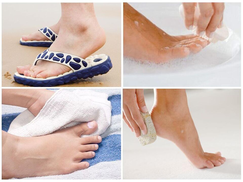 Prevention of onychomycosis includes foot hygiene, use of personal items and timely pedicures